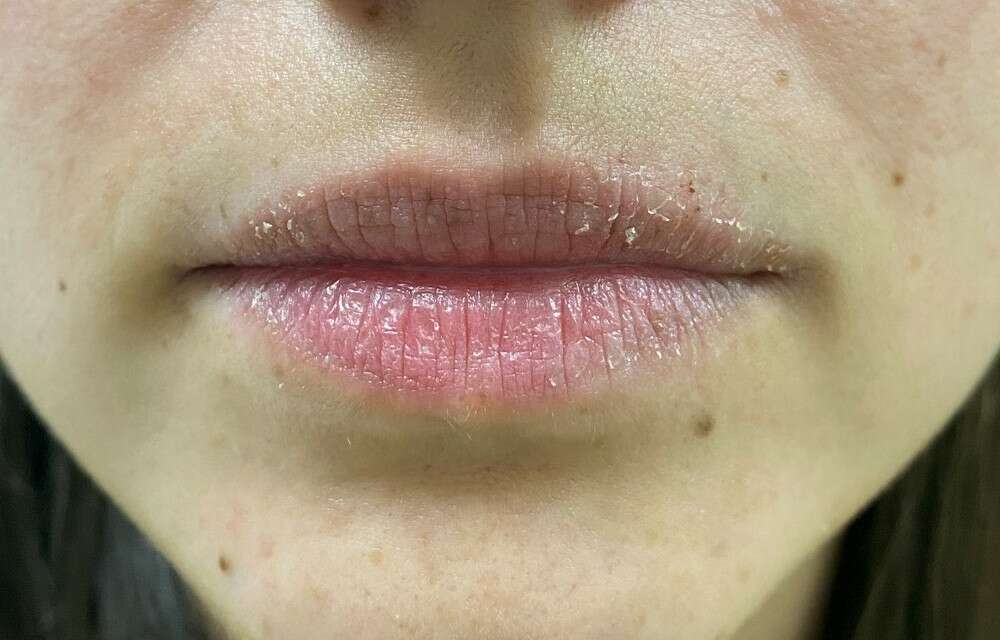 labios cortados